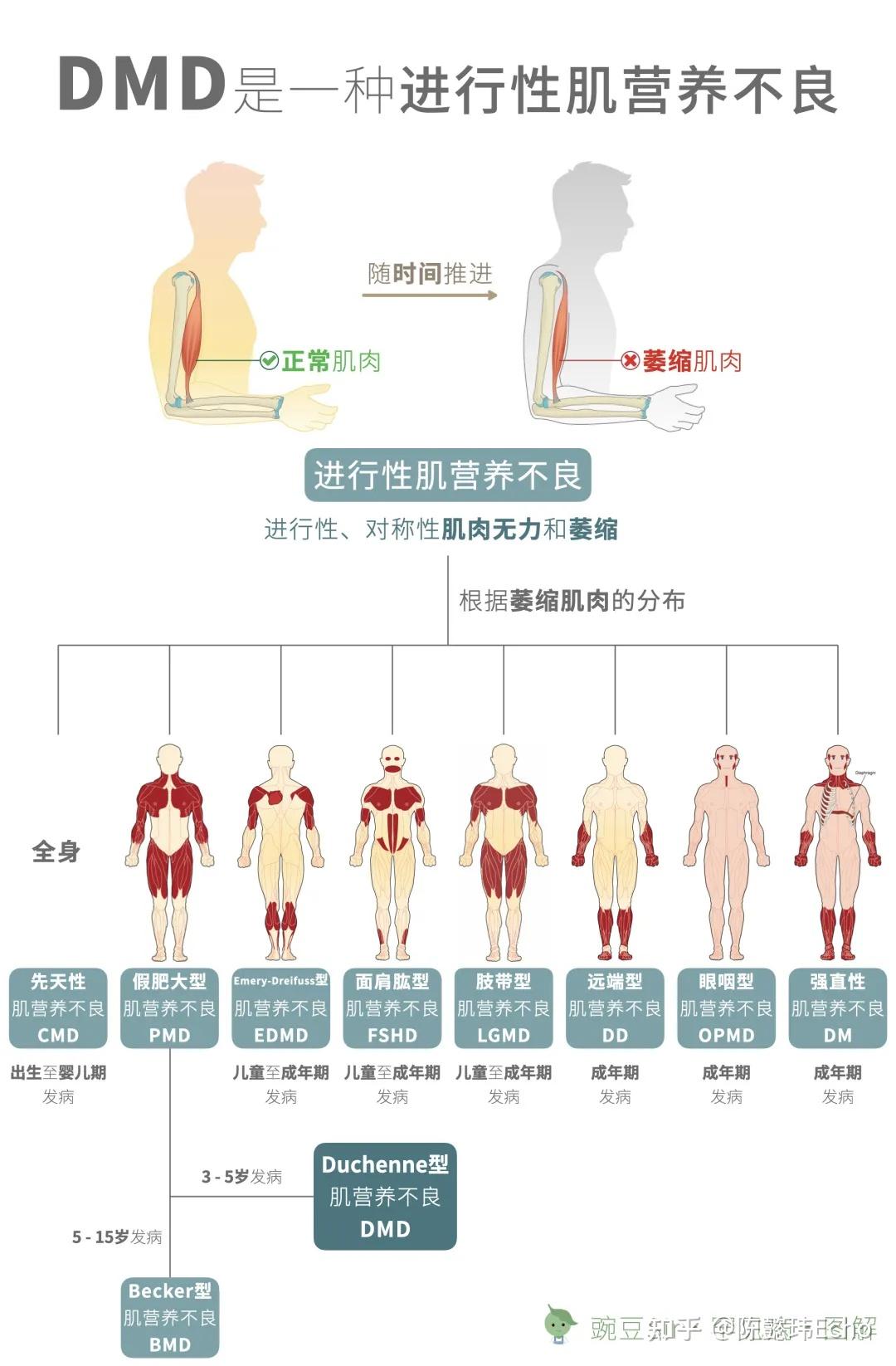 肌营养不良研究最新进展，自信与成就感的源泉