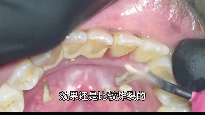 最新去牙垢科普指南，实用方法与建议